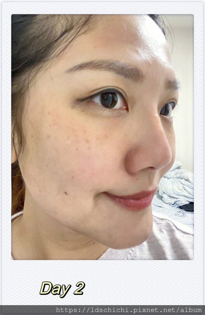 【醫美保養】賦真妍皮膚專科診所探索皮秒雷射推薦-脫下口罩也不