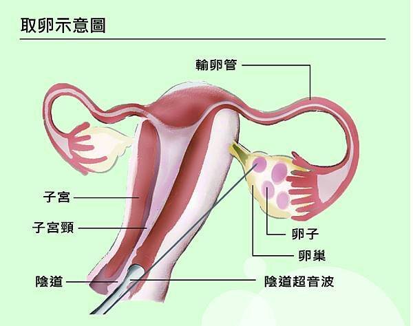 取卵示意圖.jpg