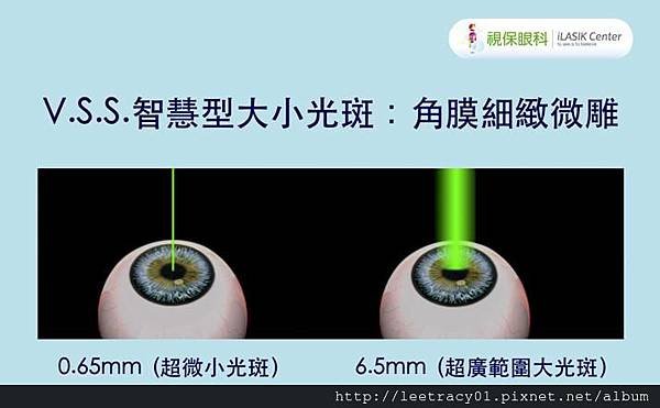 V.S.S.智慧飛點式大小光斑---視保眼科高階像差虹膜定位前導波.jpg