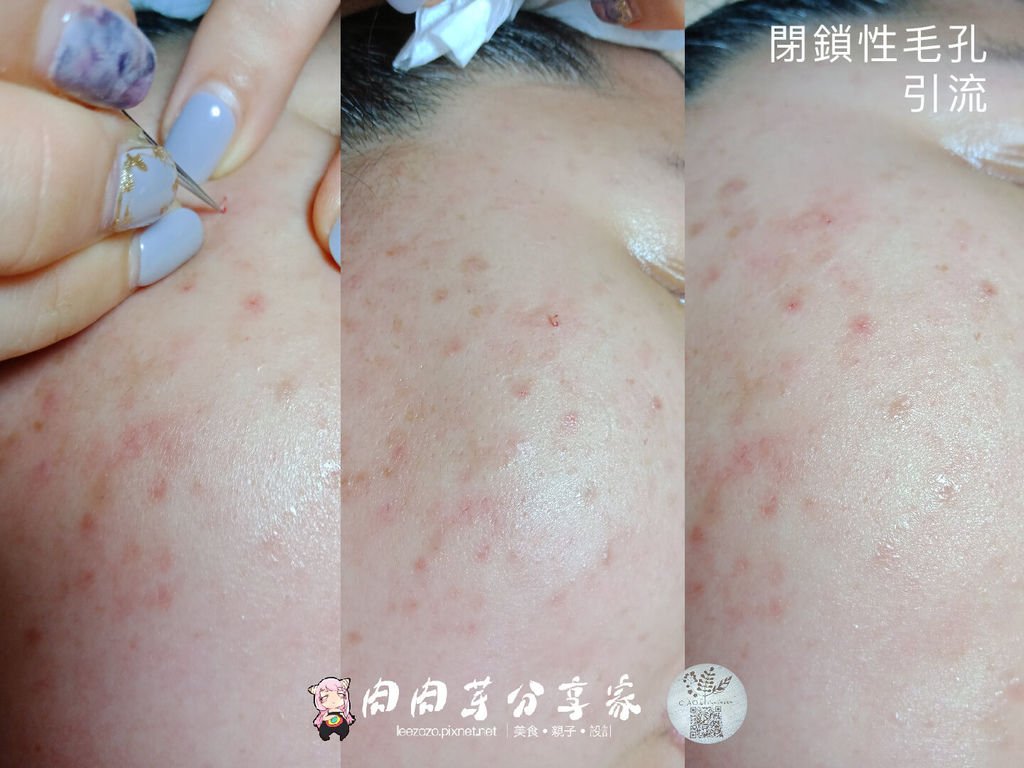 喬瑜美容5毛孔引流 (3).jpg