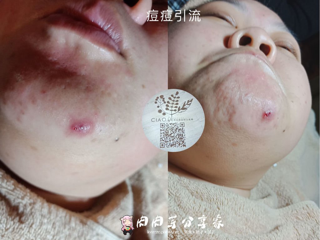 喬瑜美容5毛孔引流 (5).jpg