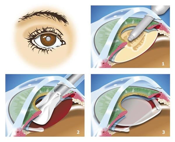 cataract-surgery-diagram