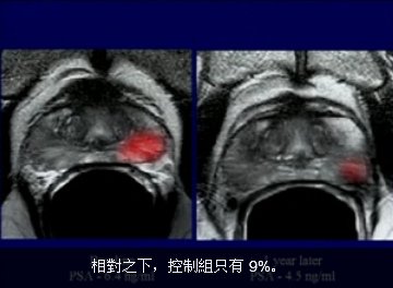 攝護線癌 照影