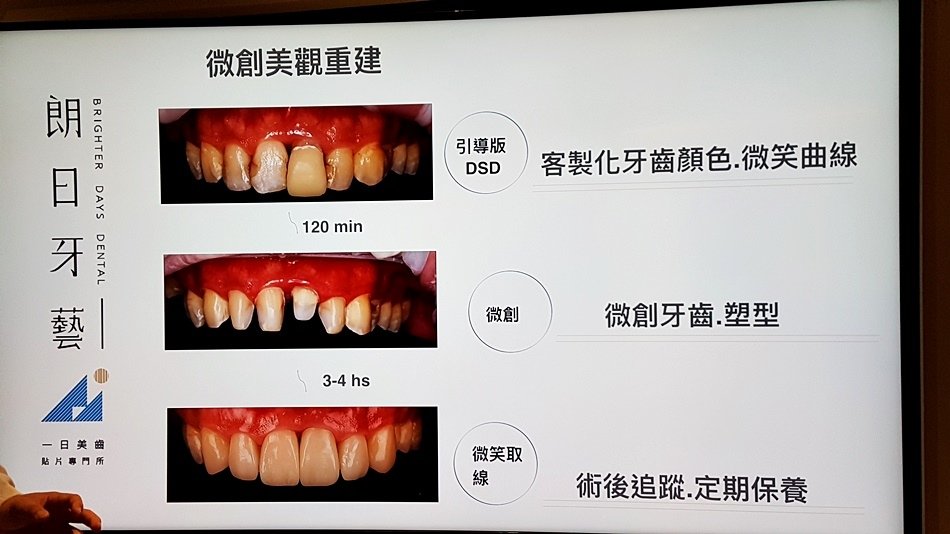 台中牙醫體驗-斷牙怎麼辦朗日牙藝美學牙醫快速補牙快速裝全瓷冠