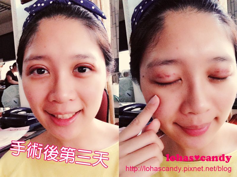 雙眼皮-8.jpg