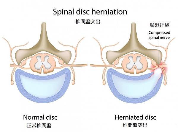 Lumbar disc herniation