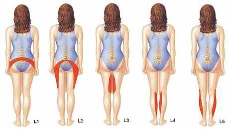 Lumbar disc herniation 02