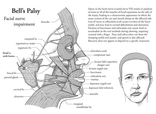 Bells-Palsy-for-web