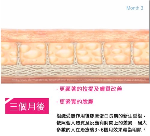 超音波拉皮Ulthera極線音波拉皮極限音波拉皮筋膜拉皮超音波拉皮電波拉皮01