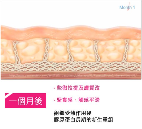 超音波拉皮Ulthera極線音波拉皮極限音波拉皮筋膜拉皮超音波拉皮電波拉皮03