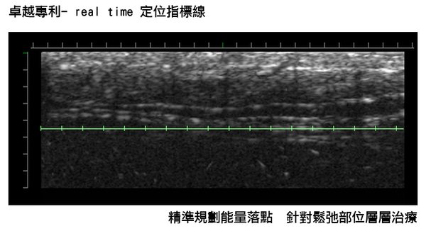 低頭族手機成癮智慧型手機雙下巴臉頰鬆垮Ultherapy極限音波拉皮液態拉皮14.jpg