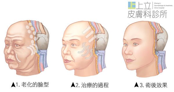 林上立 推薦 林上立 微晶瓷 林上立 肉毒桿菌 林上立 液態拉皮上立提 微晶瓷 價格 微晶瓷 隆鼻 微晶瓷 下巴 肉毒桿菌 拉提 肉毒桿菌 除皺 肉毒桿菌 價格 上立皮膚科0311.jpg