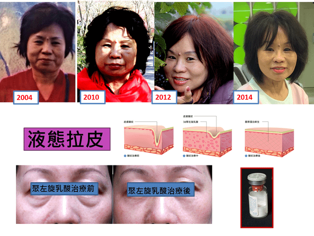 母親的液態拉皮.png