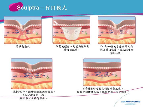 童顏針液態拉皮上立提3D聚左旋乳酸PLLA舒顏萃塑然雅sculptra025