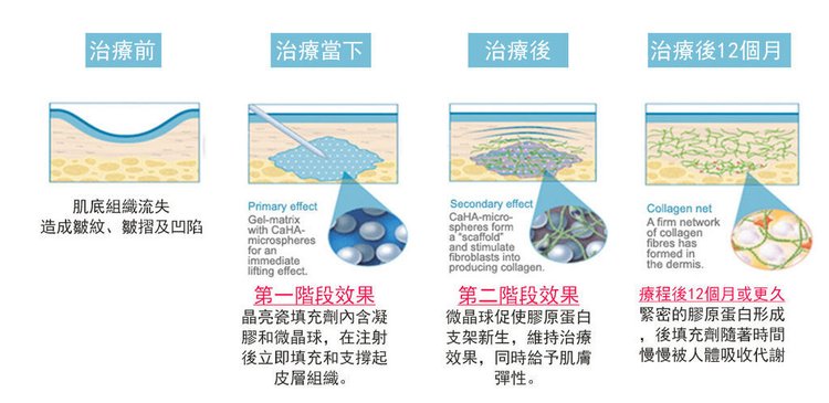 晶亮瓷微晶瓷隆鼻墊下巴晶亮瓷拉提液態拉皮.jpg