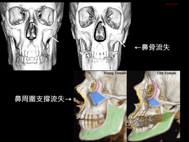 晶亮瓷微晶瓷晶亮瓷隆鼻墊晶亮瓷下巴豐額晶亮瓷價格晶亮瓷玻尿酸波酸豐唇晶亮瓷價位晶亮瓷醫師推薦03