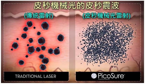 PicoSure蜂巢皮秒除皺雷射 除皺雷射 蜂巢皮秒機械光755雷射 淨膚雷射蜂巢瞬效透鏡 蜂巢皮秒機械光雷射PicoSure皮秒雷射雀斑曬斑 細紋眼下細紋毛孔粗大飛梭雷射縮毛孔淨膚雷射皮秒雷射價格皮秒雷射價錢皮秒雷射凹洞皮秒雷射除斑皮秒雷射刺青03.jpg