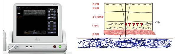 林上立 推薦 液態拉皮 推薦 極線音波拉提 推薦 極限音波拉皮 推薦 筋膜拉皮 推薦 超音波拉皮 推薦Ulthera超音波拉皮極線音波拉提筋膜拉皮超音波拉皮價格推薦07