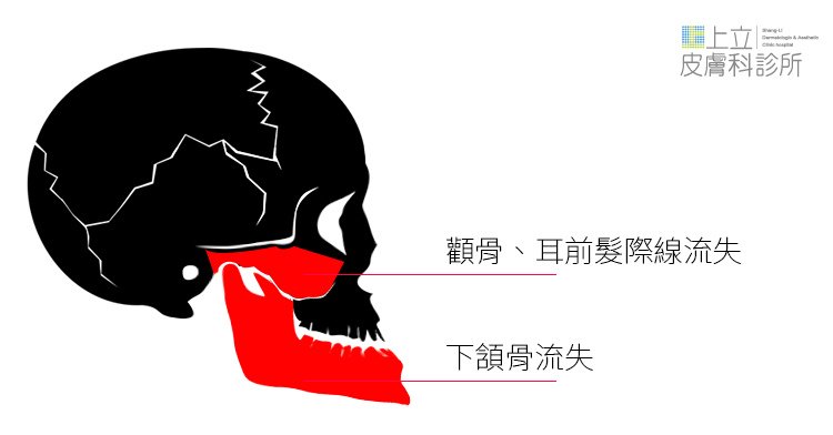 少女計劃林上立醫生液態拉皮上立提 液態拉皮 推薦 3D聚左旋乳酸 舒顏萃 童顏針 3D聚左旋乳酸 價格 3D聚左旋乳酸 費用 Ellansé 洢蓮絲少女針PolycaprolactonePCL膠原增生劑易麗適依戀詩法令紋木偶紋淚溝眼袋02.jpg