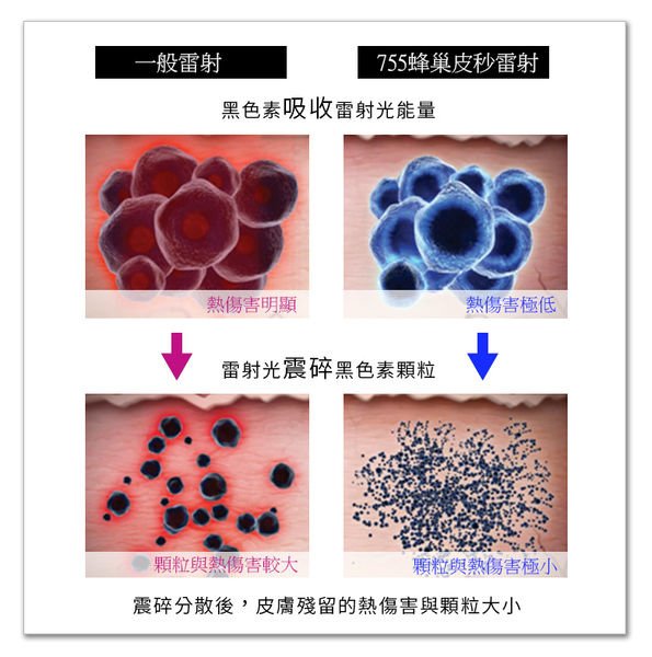 picosure755皮秒雷射蜂巢皮秒雷射蜂巢透鏡二代皮秒超皮秒新一代皮秒淨膚雷射飛梭雷射5.jpg