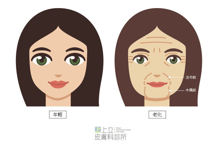 少女計劃林上立醫生液態拉皮上立提 液態拉皮 推薦 Ellansé 洢蓮絲少女針PolycaprolactonePCL膠原增生劑易麗適依戀詩聚己內酯木偶紋02.jpg
