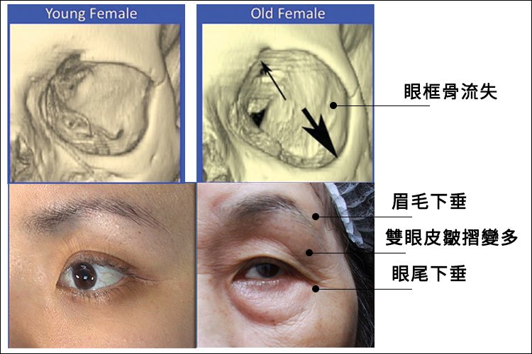 林上立醫生液態拉皮上立提Ellansé 洢蓮絲少女針PolycaprolactonePCL膠原增生劑易麗適依戀詩聚己內酯 洢蓮絲眼尾下垂 洢蓮絲眉毛下垂眼周緊實01