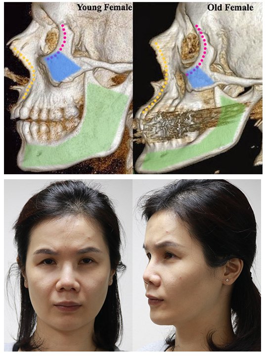 林上立醫生液態拉皮上立提Ellansé 洢蓮絲少女針PolycaprolactonePCL膠原增生劑易麗適依戀詩聚己內酯 洢蓮絲雙頰凹陷洢蓮絲豐頰洢蓮絲蘋果肌02.jpg