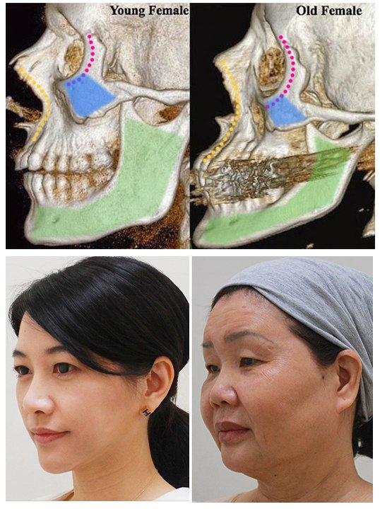 IMCAS上立醫生液態拉皮上立提Ellansé 洢蓮絲少女針PolycaprolactonePCL膠原增生劑易麗適依戀詩聚己內酯04.jpg