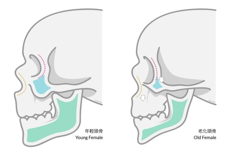 林上立醫生液態拉皮上立提Ellansé 洢蓮絲少女針PolycaprolactonePCL膠原增生劑易麗適依戀詩聚己內酯埋線拉皮3D聚左旋乳酸童顏針舒顏萃02.jpg