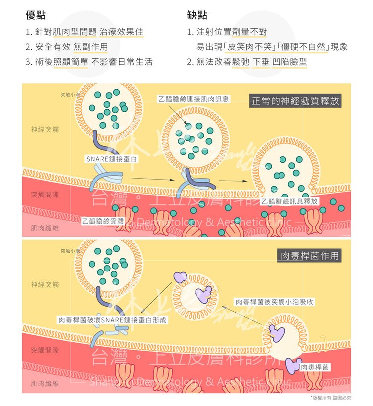 林上立醫生液態拉皮上立提Ellansé 洢蓮絲少女針PolycaprolactonePCL膠原增生劑易麗適依戀詩聚己內酯埋線拉皮3D聚左旋乳酸童顏針舒顏萃肉毒桿菌01.jpg