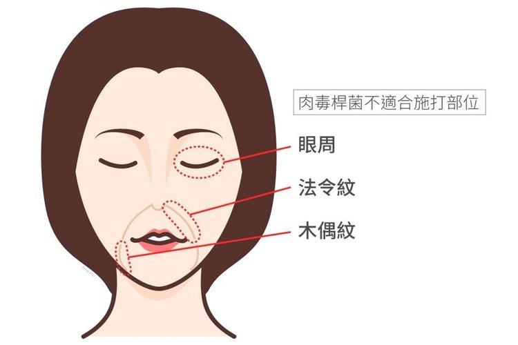 林上立醫生液態拉皮上立提Ellansé 洢蓮絲少女針PolycaprolactonePCL膠原增生劑易麗適依戀詩聚己內酯埋線拉皮3D聚左旋乳酸童顏針舒顏萃肉毒桿菌05.jpg