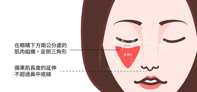 林上立醫生液態拉皮上立提Ellansé 洢蓮絲少女針PolycaprolactonePCL膠原增生劑易麗適依戀詩聚己內酯3D聚左旋乳酸童顏針舒顏萃蘋果肌02.jpg