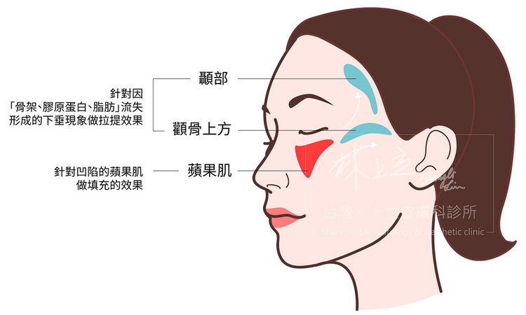 林上立醫生液態拉皮上立提Ellansé 洢蓮絲少女針PolycaprolactonePCL膠原增生劑易麗適依戀詩聚己內酯3D聚左旋乳酸童顏針舒顏萃蘋果肌04.jpg