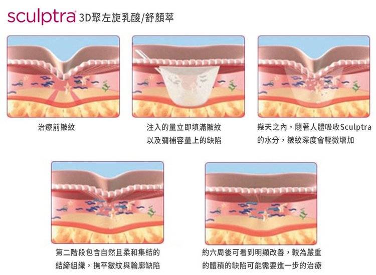 林上立醫師3D聚左旋乳酸Sculptra舒顏萃上立皮膚科微整型 (4).jpg