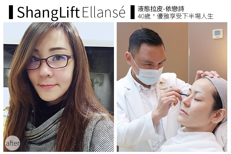 少女計劃林上立醫生液態拉皮上立提 液態拉皮 推薦 Ellansé 洢蓮絲少女針PolycaprolactonePCL膠原增生劑易麗適依戀詩拉皮緊實鬆垮下垂膠原蛋白增生