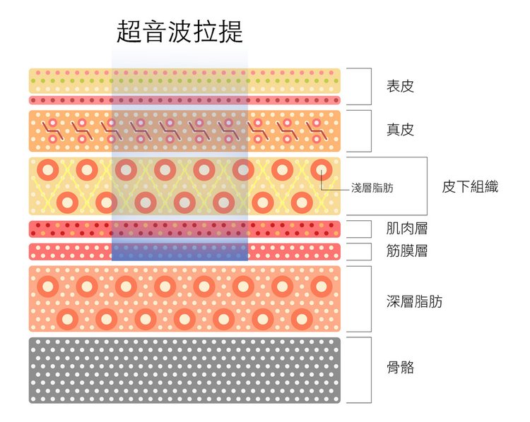 液態拉皮超音波拉提林上立醫師微整型抗老拉提法令紋下垂皺紋鬆弛下顎線.jpg