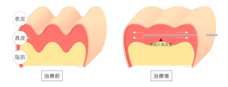 液態拉皮上立提Ellansé 洢蓮絲少女針PolycaprolactonePCL膠原增生劑易麗適依戀詩聚己內酯 洢蓮絲雙頰下垂蘋果肌拉提緊實04.jpg