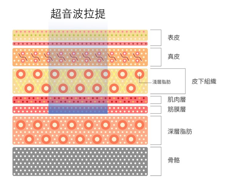 上立皮膚科超音波拉皮一態拉皮Ellanse洢蓮絲抗老拉提膠原蛋白增生劑 (3).jpg