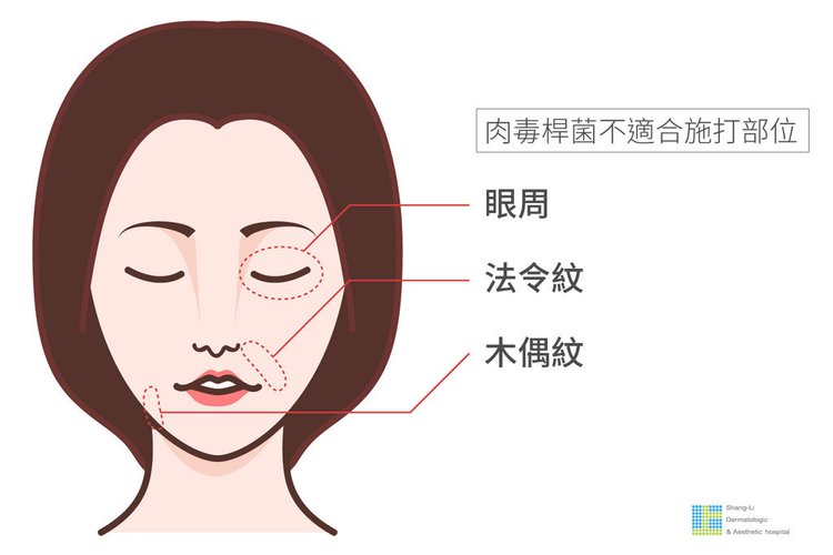 上立皮膚科肉毒桿菌botox咀嚼肌法令紋皺紋凹陷填補林上立醫師 (6).jpg