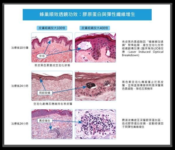 上立皮膚科755皮秒雷射蜂巢式聚焦陣列透鏡除斑美白3