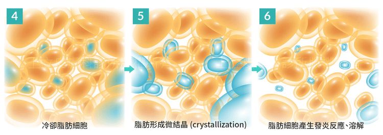 冷凍溶脂三張下