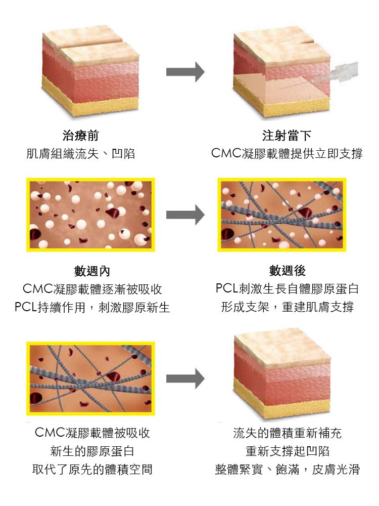 洢蓮絲ellanse聚己內酯PCL少女針易麗適依戀詩液態拉皮舒顏萃sculptra童顏針3D聚左旋乳酸淚溝作用原理不一樣架個價位5.jpg