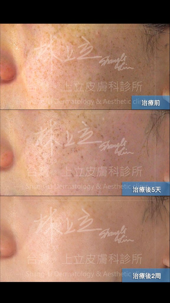 雷射去除淺層斑一定會結痂-但PicoSure755蜂巢皮秒雷射把結痂變的不明顯-只有很細小像胡椒粒大小的結痂