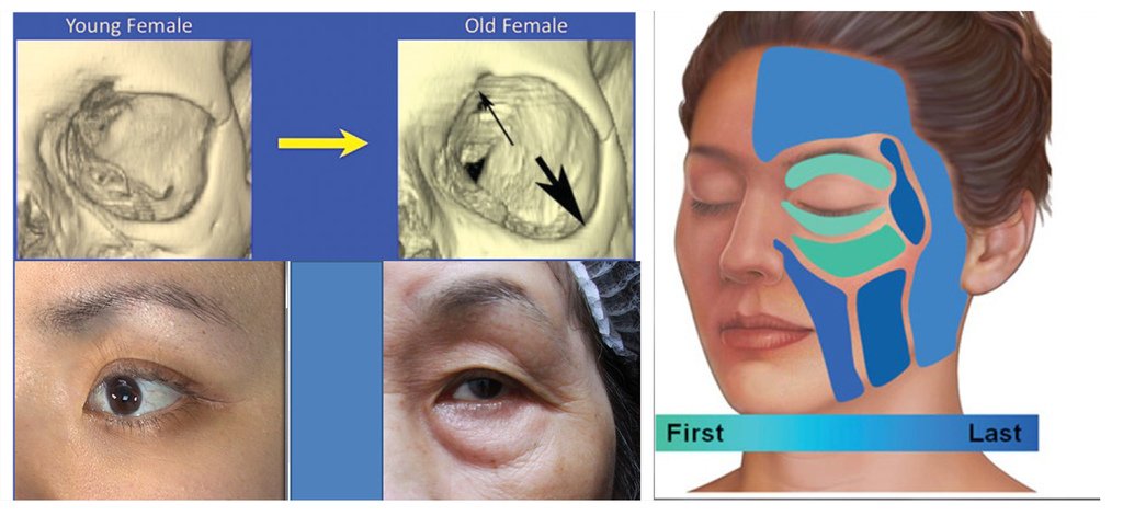 dark circles around hisher eyes-tear trough-ellanse (3).jpg