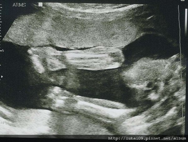 20 week Ultrasound - arms.jpg