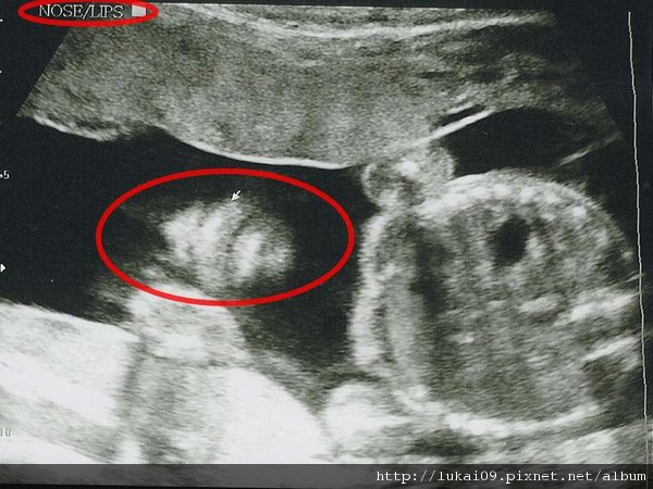 20 week Ultrasound - Nose and Lips.jpg