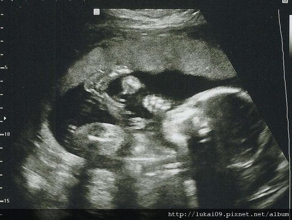 20 week Ultrasound - Whole Body.jpg