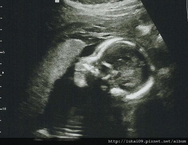 20 week Ultrasound - Head Profile 2.jpg