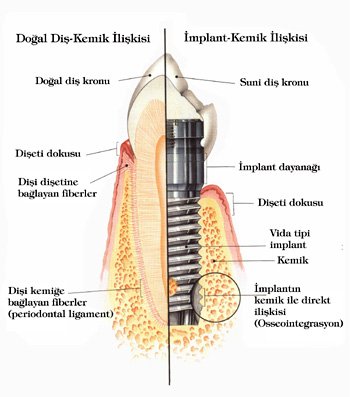 implant