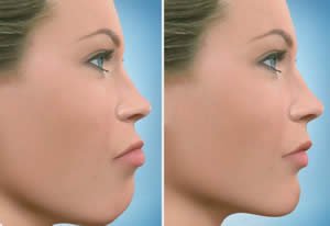 Posterior%20Impaction%20before%20&amp;%20after